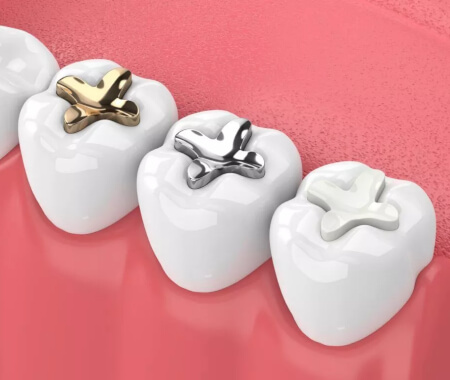 Dental implant