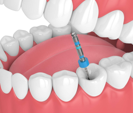 Dental implant